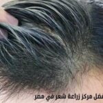 افضل مركز زراعة شعر في مصر